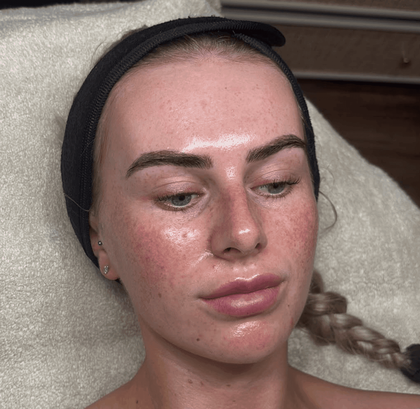 Hydra facial treatment result