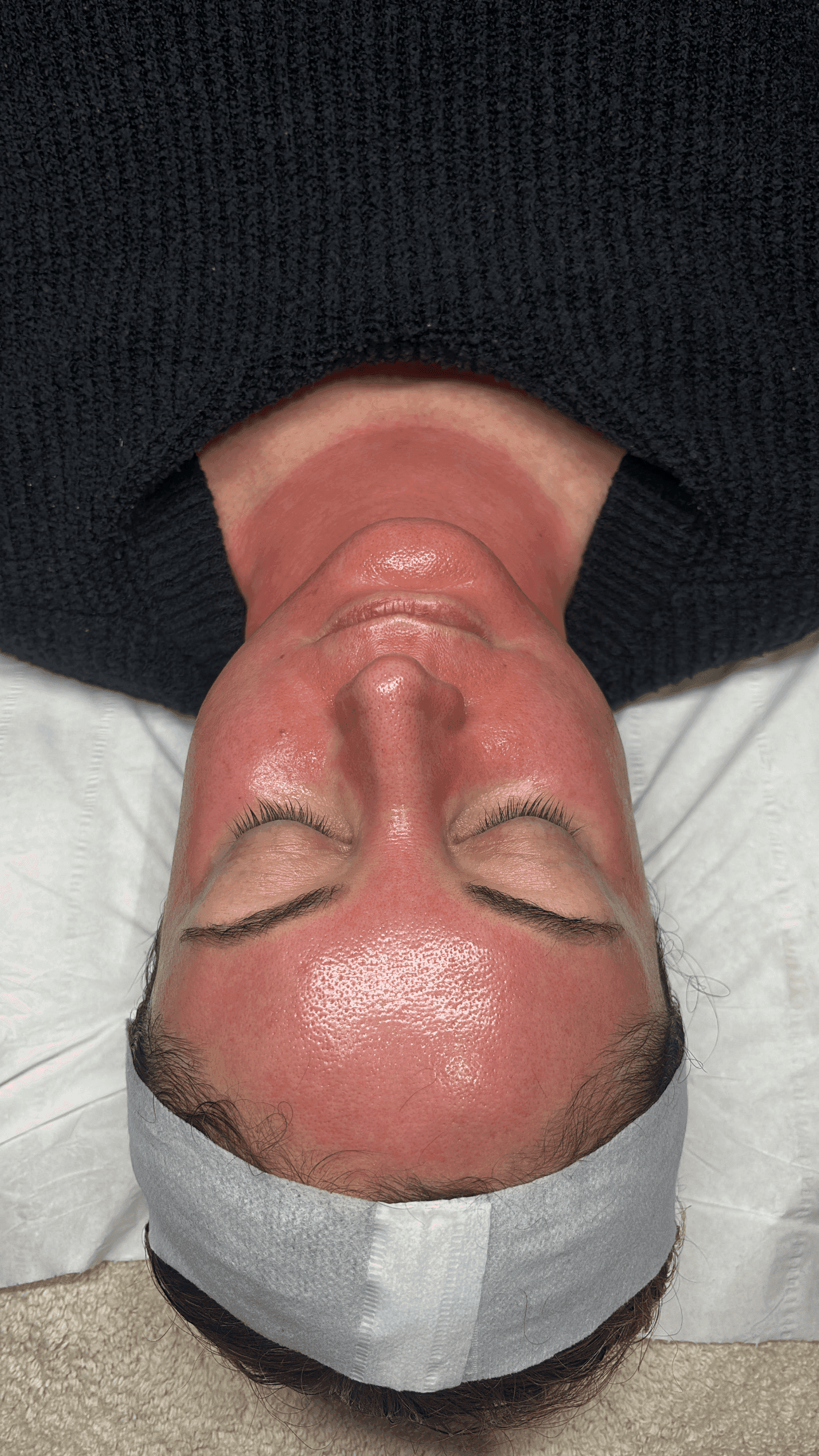 Microneedling treatment result